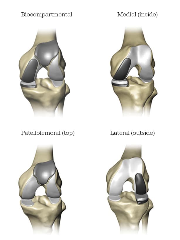 Mako robotic Knee replacement