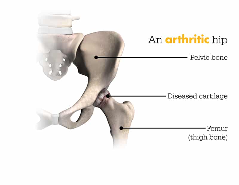 Mako robotic Hip replacement Service