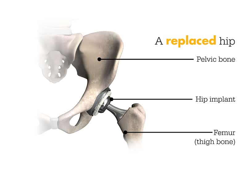 Mako robotic Hip replacement