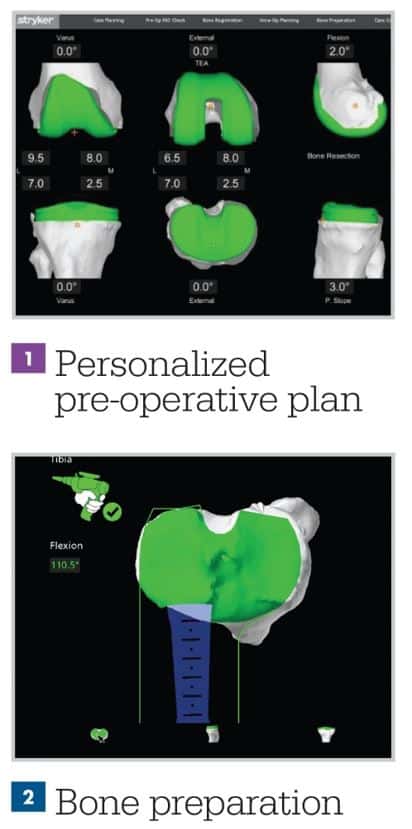 Mako Robotic-Arm Assisted Technology For Total Knee Replacement