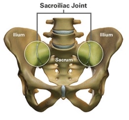 Sacroiliac Joint Pain Removal