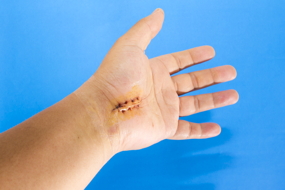 expect recovery hand surgery